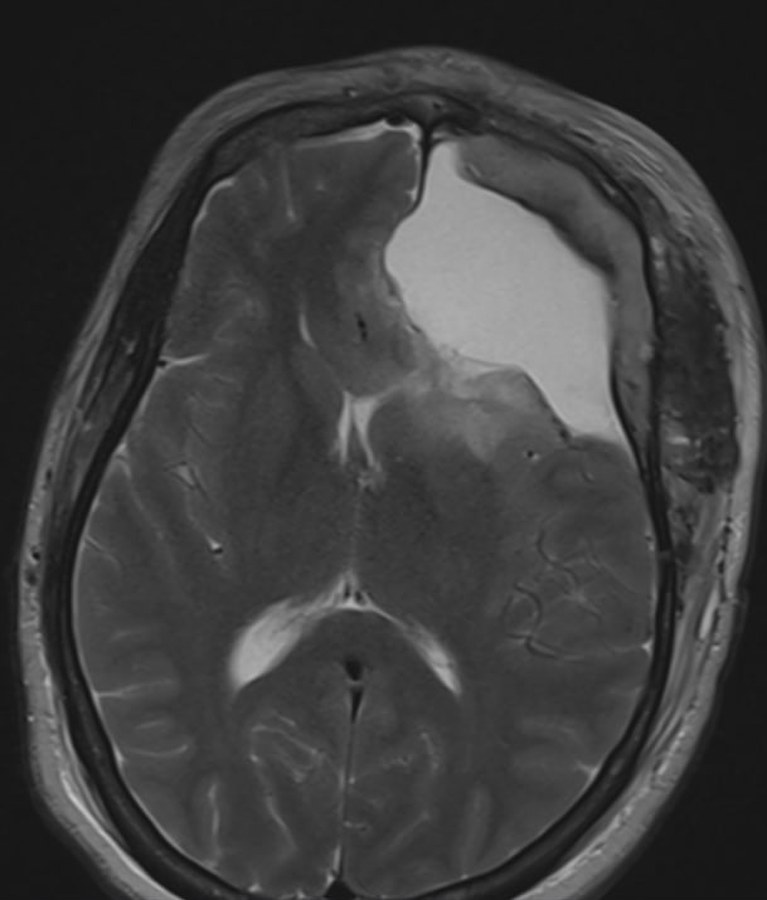 Post-operative axial T2 MRI showing the resection cavity where the tumour was