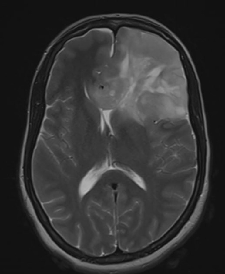 Pre-operative axial T2 MRI showing a glioma in the left fronto-temporal region
