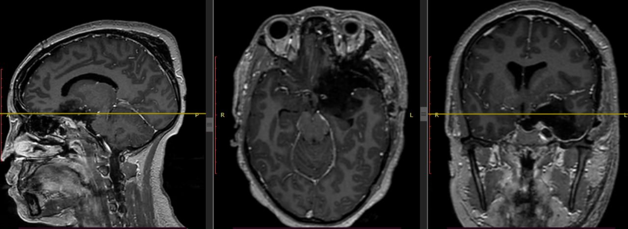 Post-operative contrast MRI in the same three planes showing the mass fully resected