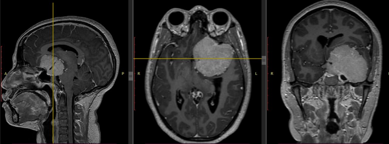 Pre-operative contrast MRI in three planes showing a large enhancing mass at the left clinoid