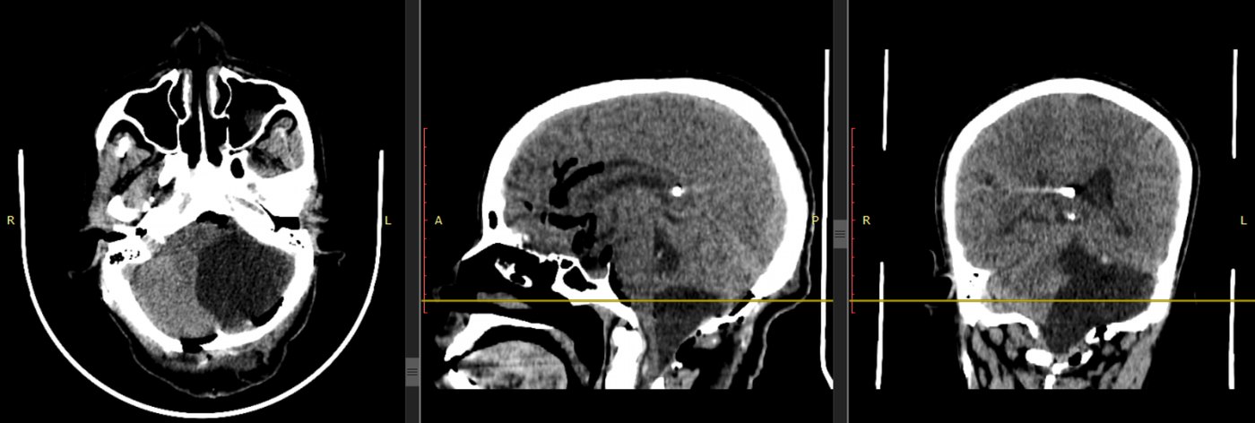 Post-operative CT in three planes showing the posterior fossa clear after resection
