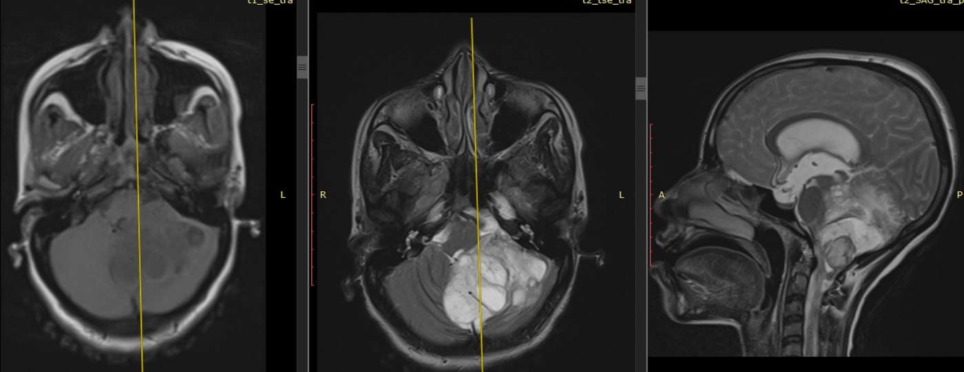 Pre-operative MRI in three planes showing a bright mass filling the posterior fossa
