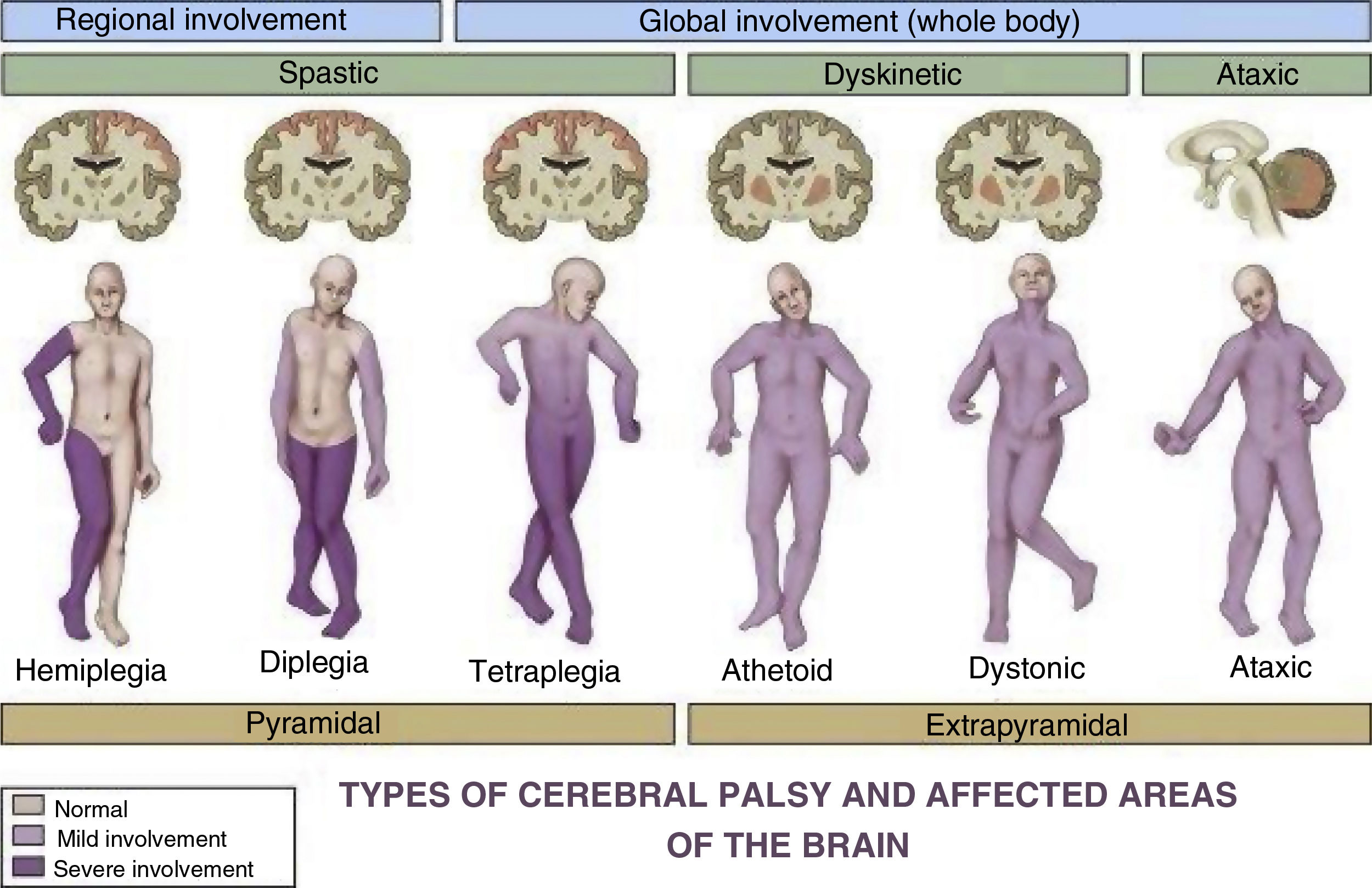 Types of spasticity