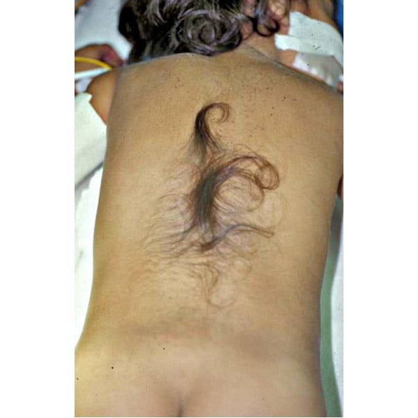 skin manifestation of spinabifida