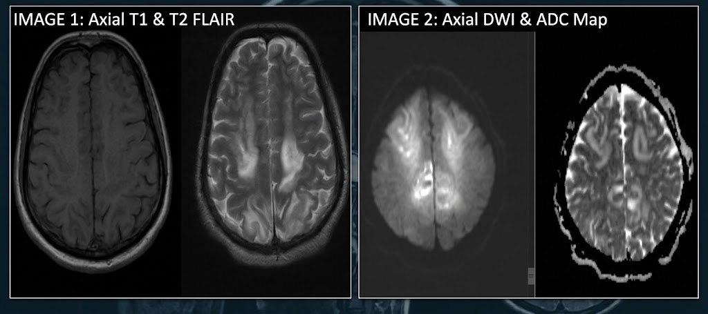 T1 ,t2 DWI and ADC map images of PRES In 30 year old eclamptic patient