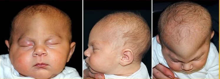 a child with metopic synostosis