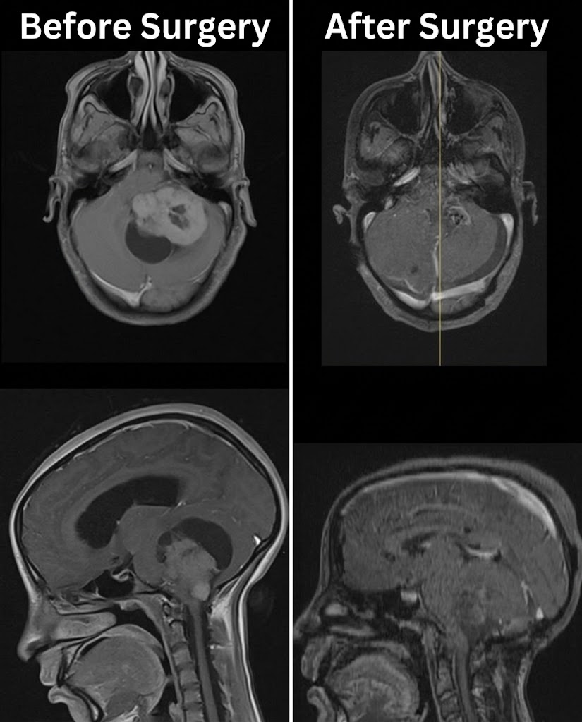 posterior fossa mass before and after surgery